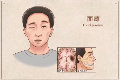 面癱導致歪嘴多年還有希望康復嗎